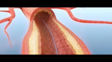 血管扩张支架手术动画视频素材