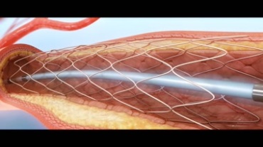 血管扩张支架手术动画视频素材